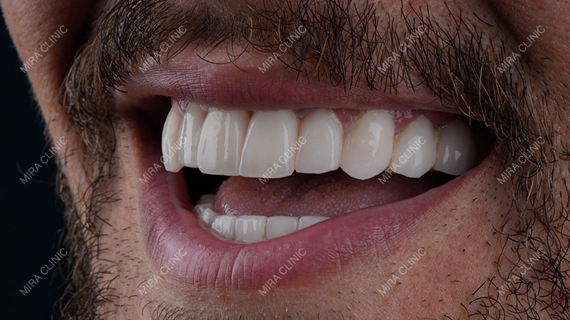 Affordable Veneers